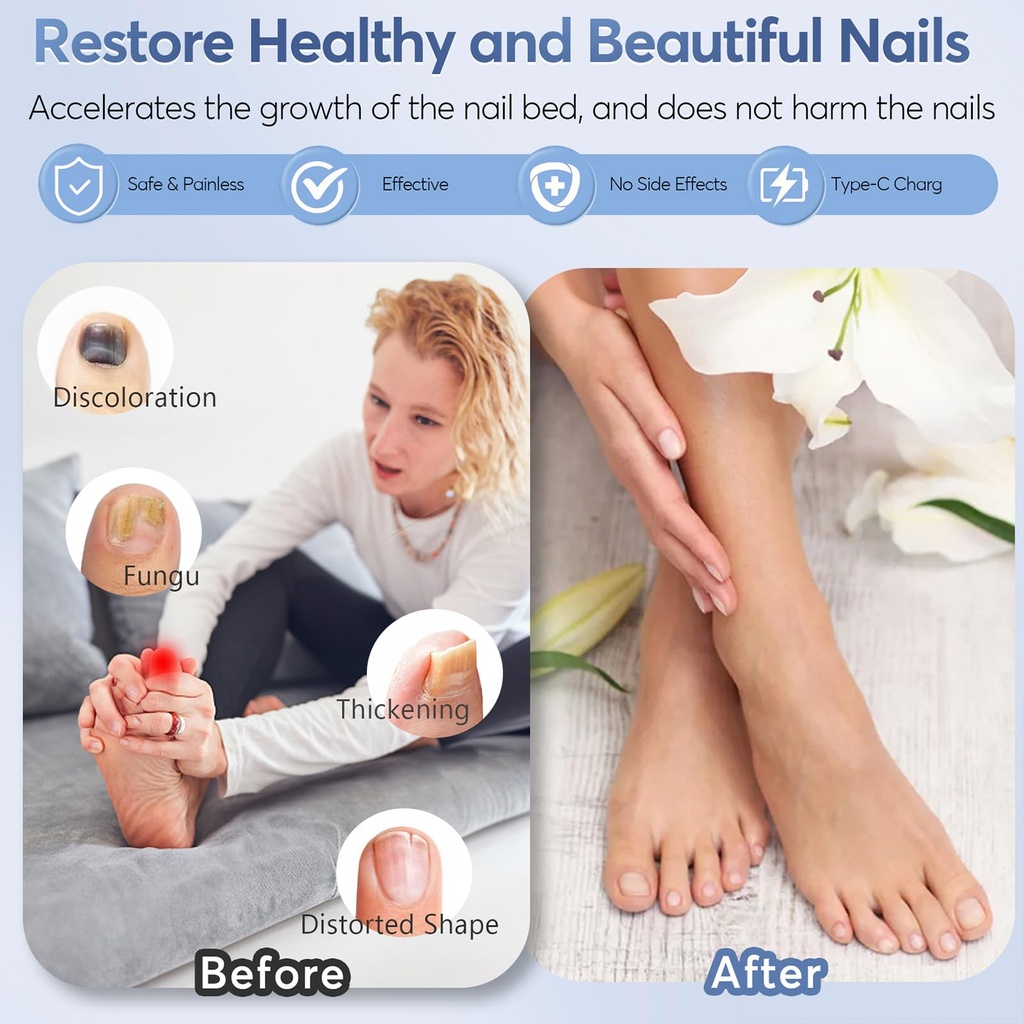 nail-fungus-laser-treatment-led-light-de-3.jpg